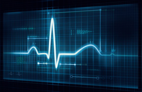 Electrocardiogram (ECG) trace. An ECG measures the electrical activity of the heart.