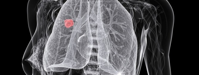 x-ray of lung cancer in a patient.