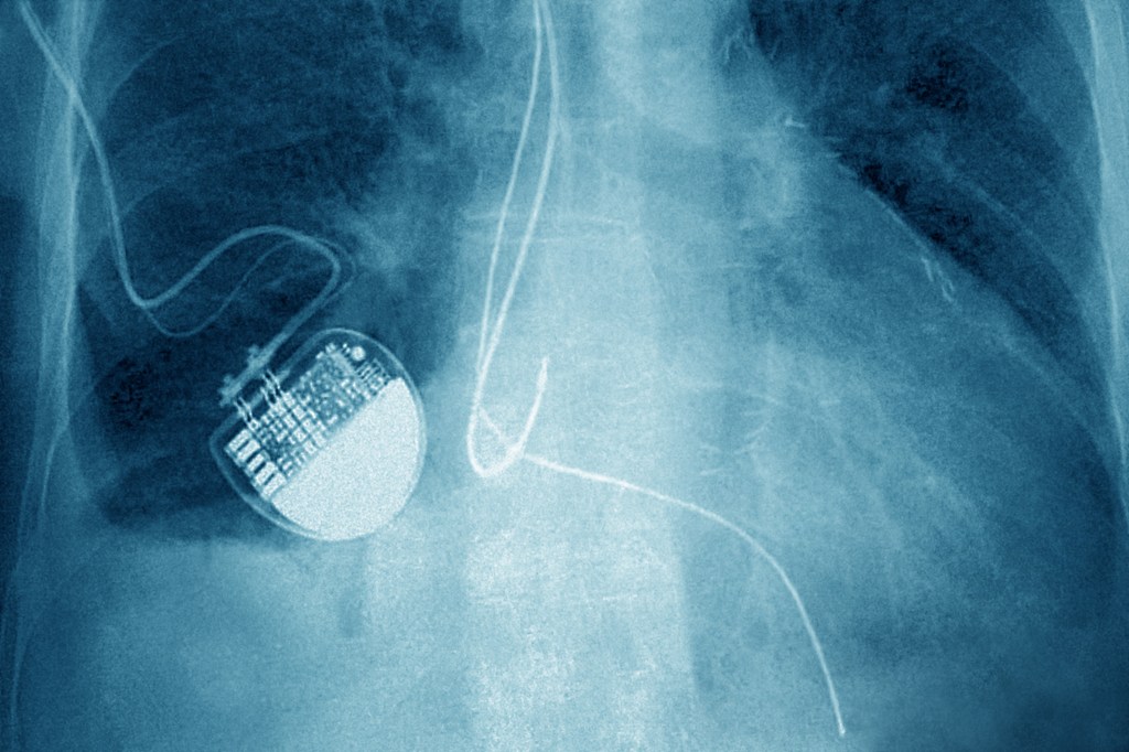 an X-ray of a pacemaker