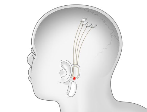 Neuralink graphic