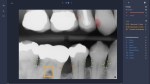 Overjet, dental care, oral care