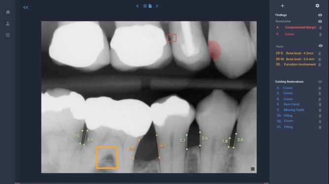 Overjet, dental care, oral care