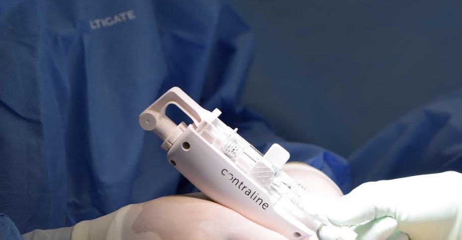 doctor with Contraline contraceptive implant apparatus